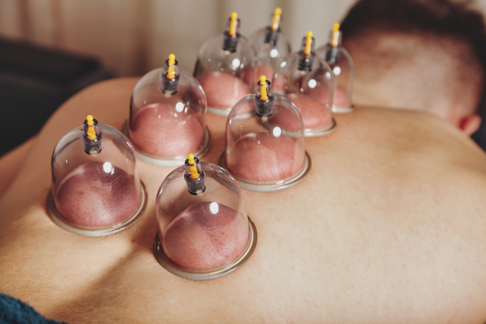 Hijama (Cupping Therapy)